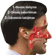 užnosinis lašėjimas