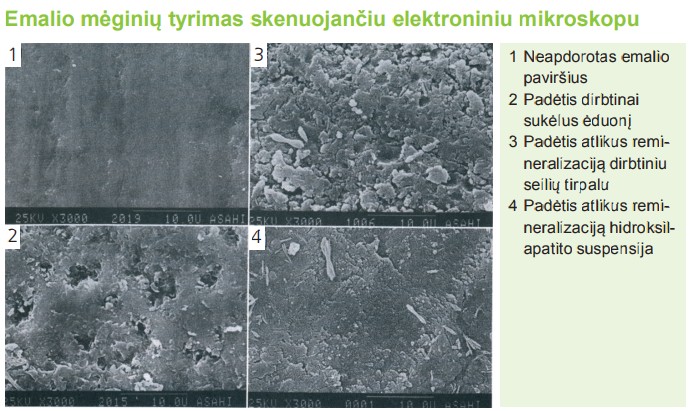 Hidroksilapatito suspensijos skatina remineralizaciją
