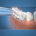 Waterpik Pik Pocket antgalis dantenų kišenėms