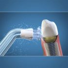 Waterpik šepetėlis implantams